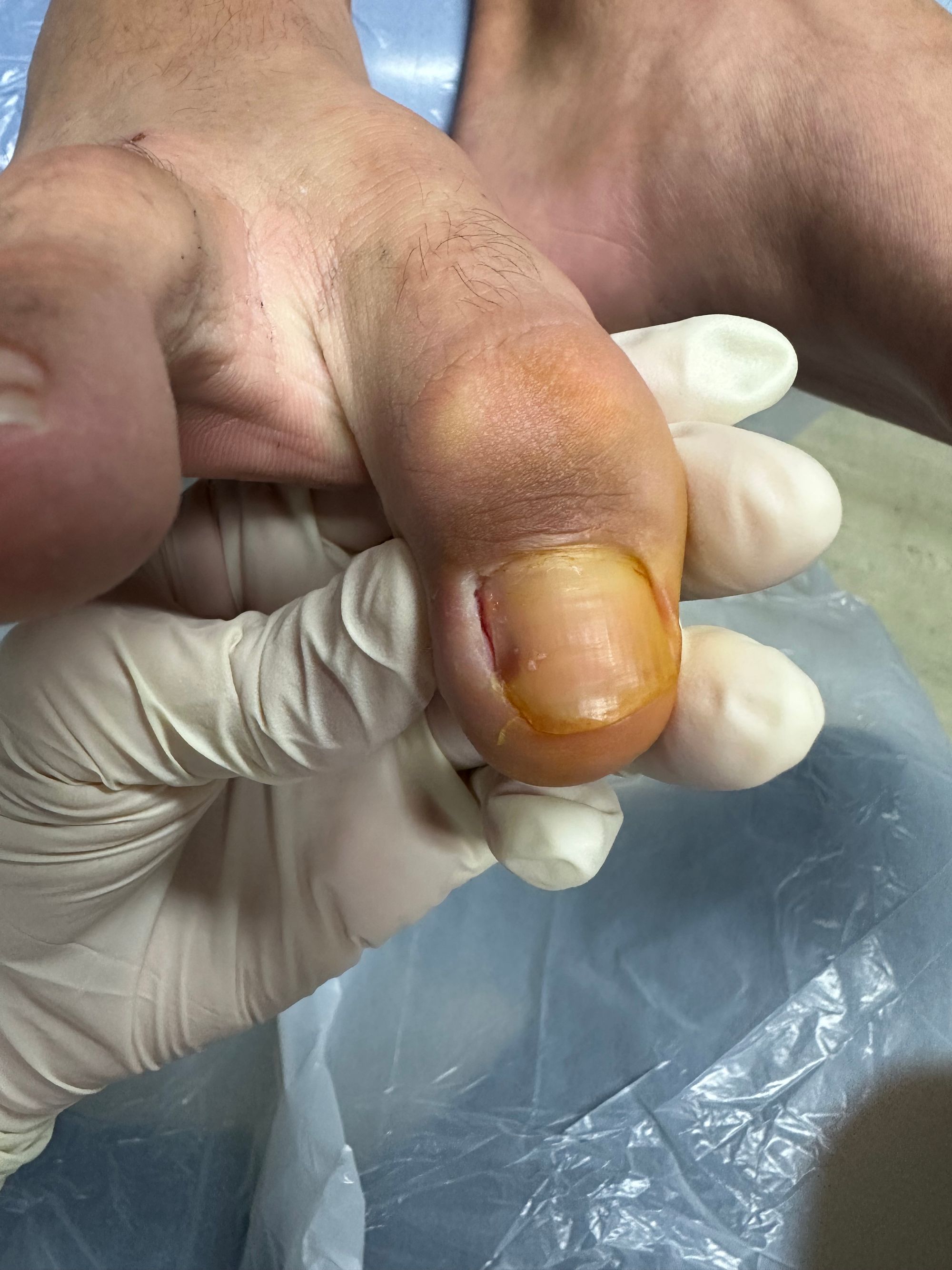 Ingrown Toenails: Everything you need to know.