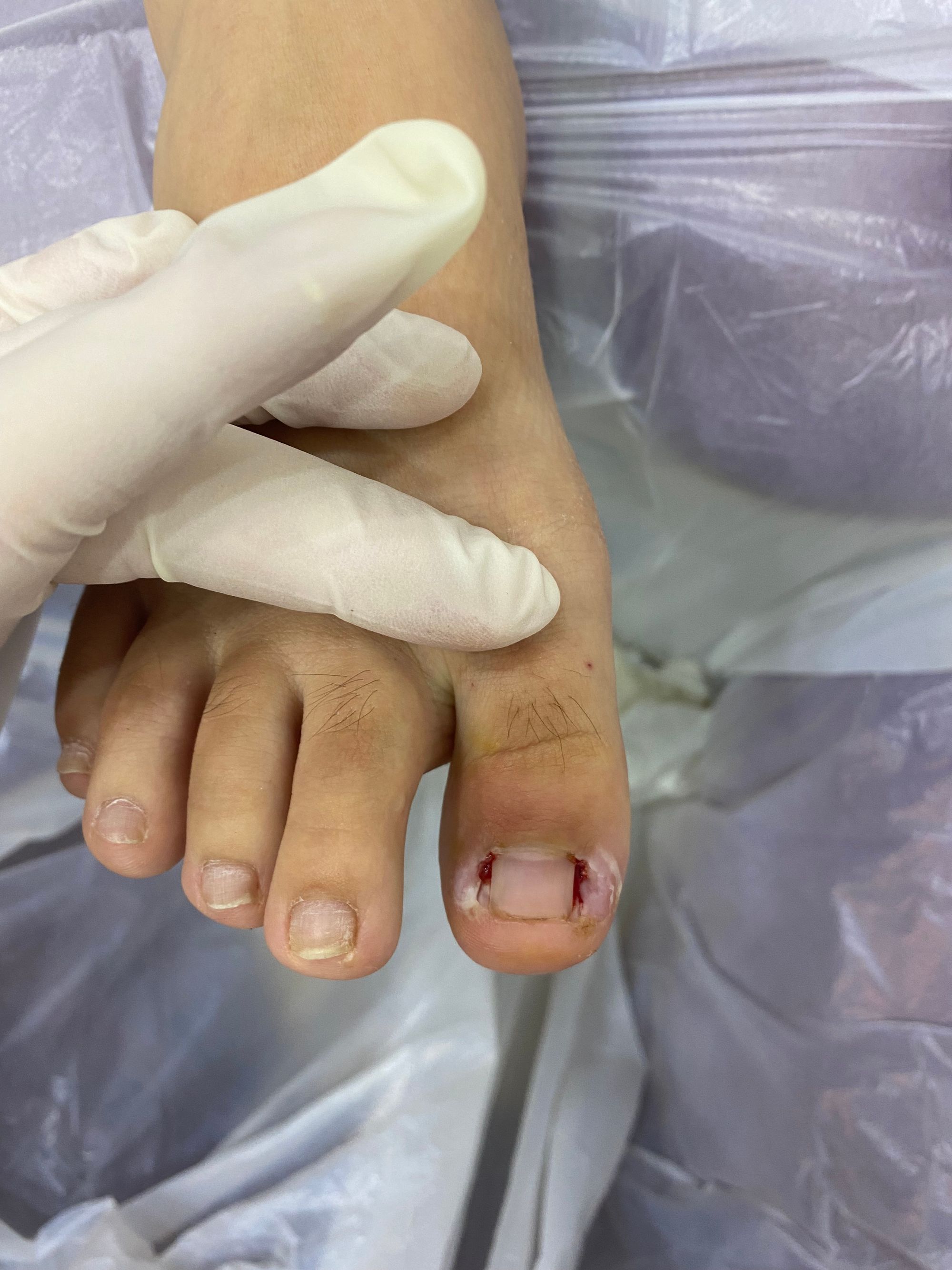 Ingrown Toenails: Everything you need to know.